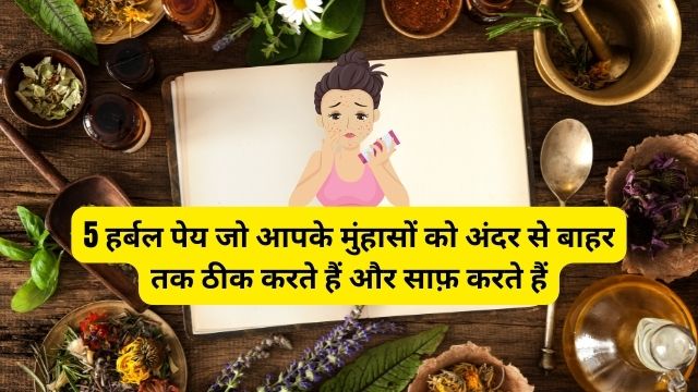 Herbal Home remedies for Pimples
